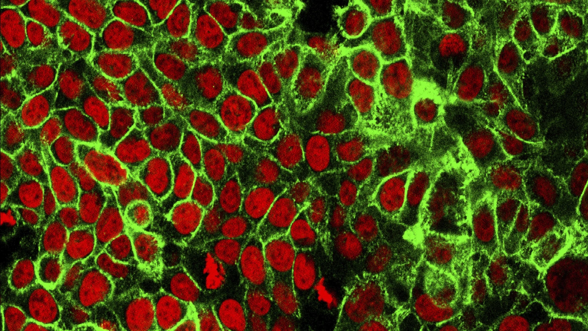 Imagen microscópica de células cancerígenas en el colon