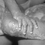 Lesiones en humano producidas por la viruela de los monos.