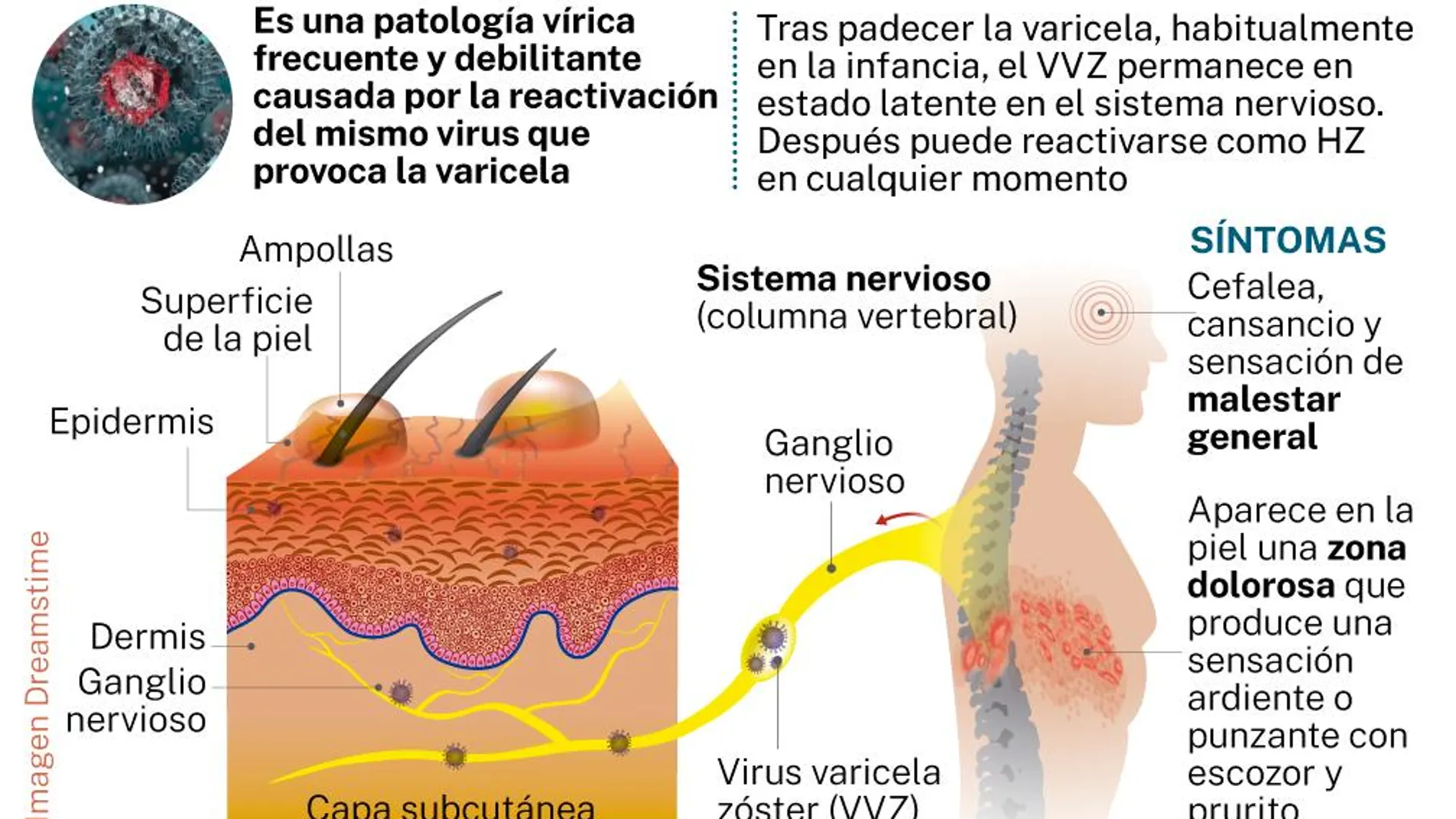 Herpes zóster