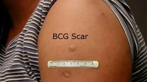 Diferencias entre la cicatriz que deja la vacuna de la tuberculosis BCG (arriba) y la de la vacuna de la viruela (debajo)