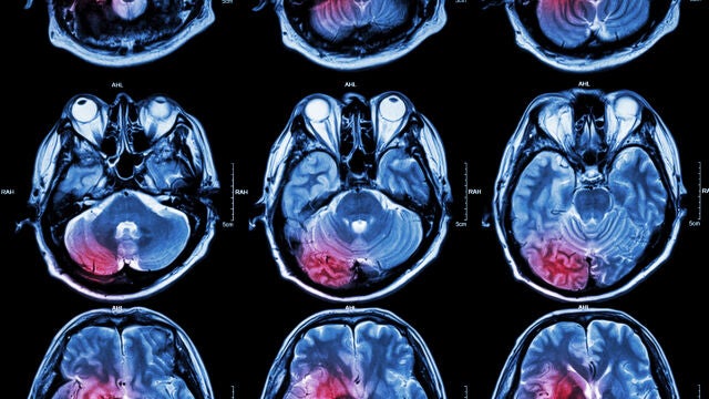 Resonancia magnética de cerebro