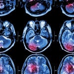 Resonancia magnética de cerebro