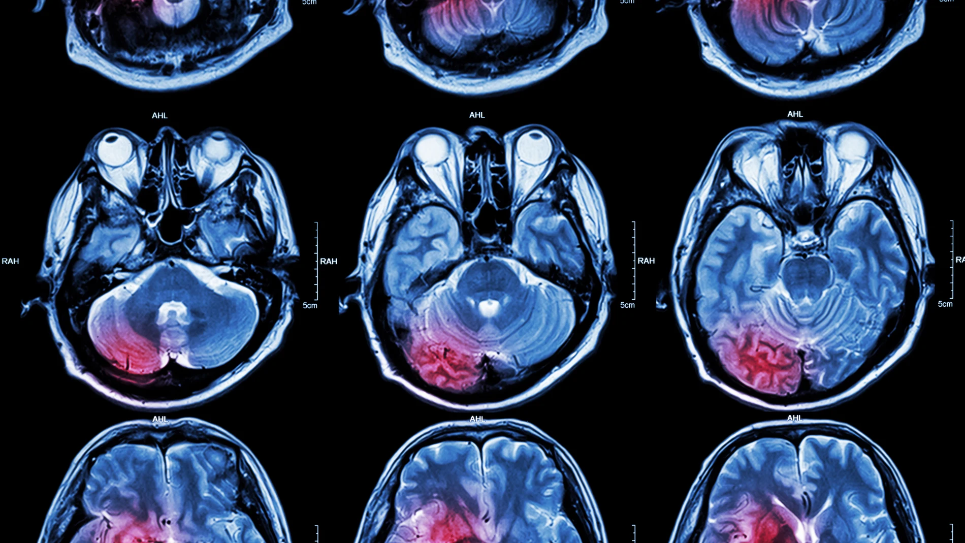 Resonancia magnética de cerebro