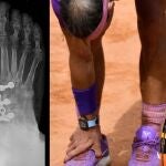 Nadal confía en mejorar con su nuevo tratamiento