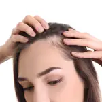 El efluvio telógeno es una de las causas más frecuentes de alopecia