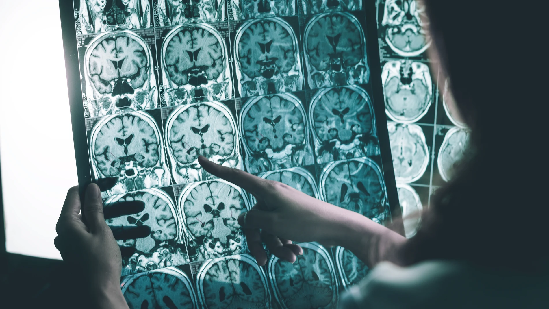 Resonancia magnética de una persona con Alzheimer