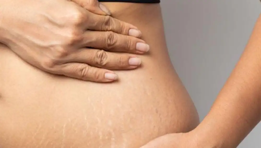 Todavía no existe un método infalible para eliminar estrías | Fuente: ObjetivoBienestar