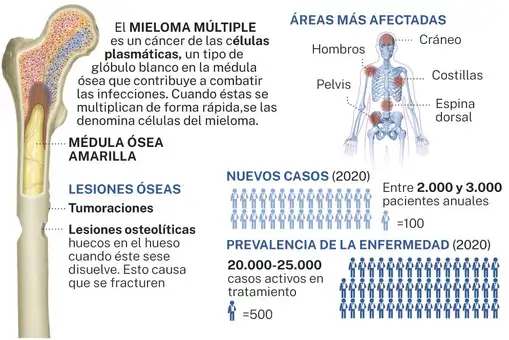 La terapia que erradica los rastros de mieloma múltiple La terapia que erradica los rastros de mieloma múltiple