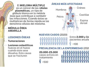 Mieloma múltiple Mieloma múltiple
