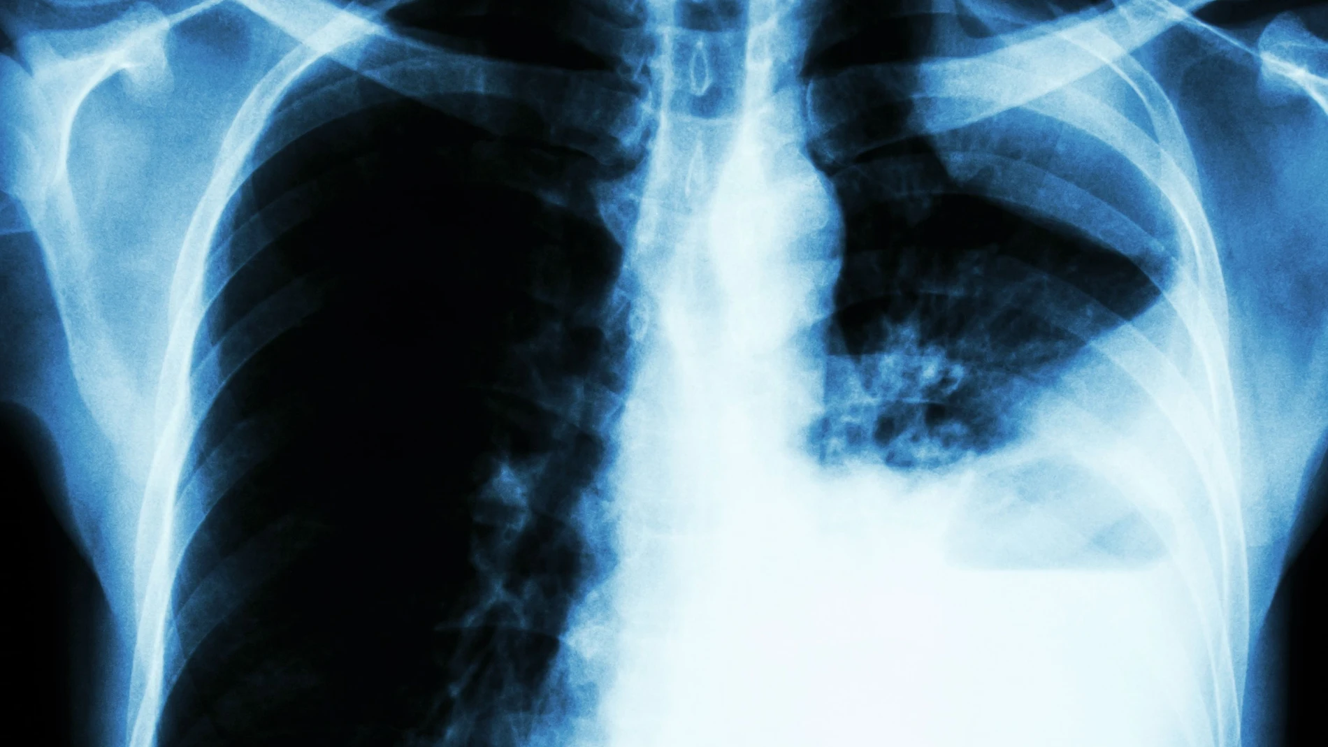 Cáncer de pulmón