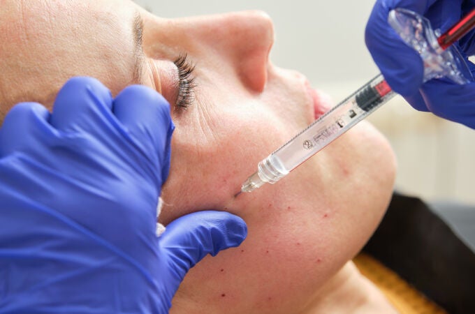 Una mujer se somete a una mesoterapia facial con ácido hialurónico