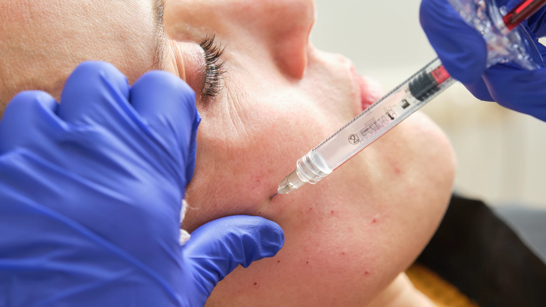 Una mujer se somete a una mesoterapia facial con ácido hialurónico