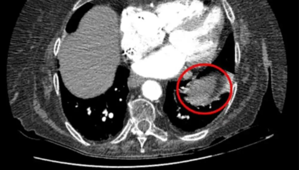 Tomografía computarizada con angiografía que muestra un área amorfa de consolidación similar a una masa en el lóbulo inferior izquierdo anterior en la base del pulmón izquierdo (círculo rojo).