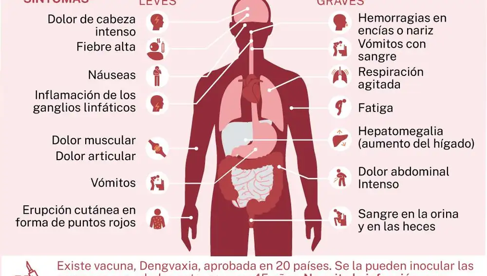 Síntomas Dengue