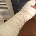 Imagen del brazo del agente de la Guardia Civil herido