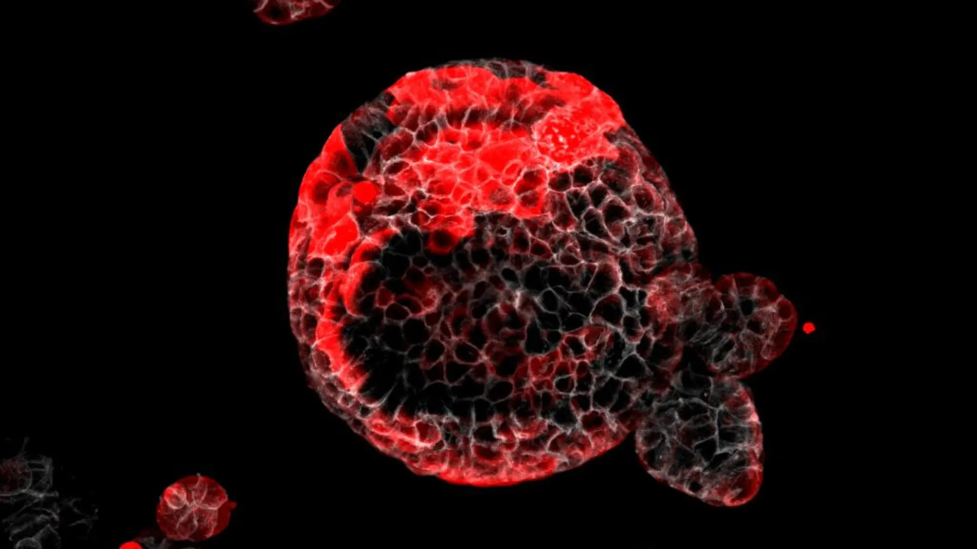 La investigación demuestra que la inmunoterapia temprana, anterior a la cirugía, puede eliminar estas células antes de que hayan iniciado el desarrollo de una metástasis y así prevenir las recaídas en la enfermedad.