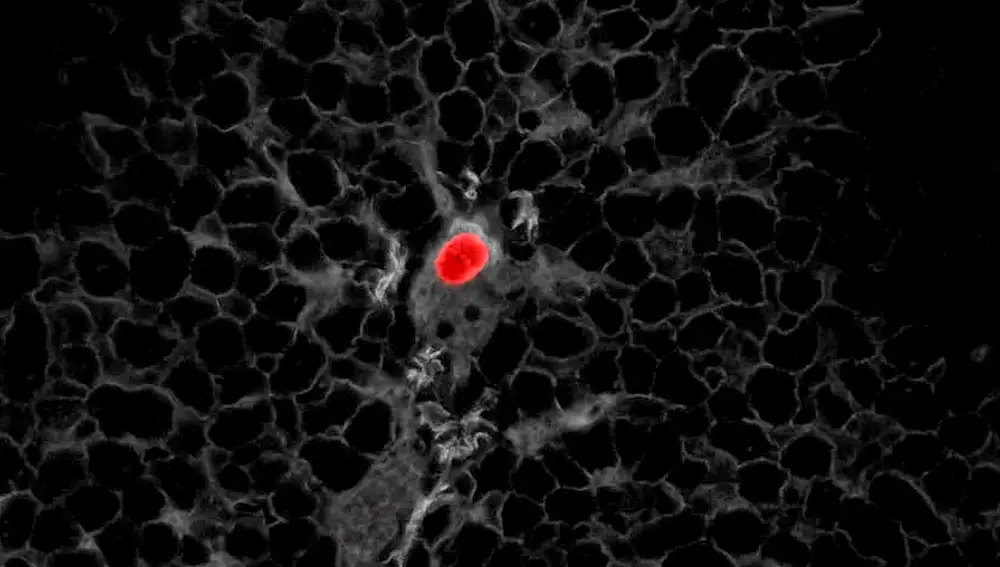 La investigación demuestra que la inmunoterapia temprana, anterior a la cirugía, puede eliminar estas células antes de que hayan iniciado el desarrollo de una metástasis y así prevenir las recaídas en la enfermedad.