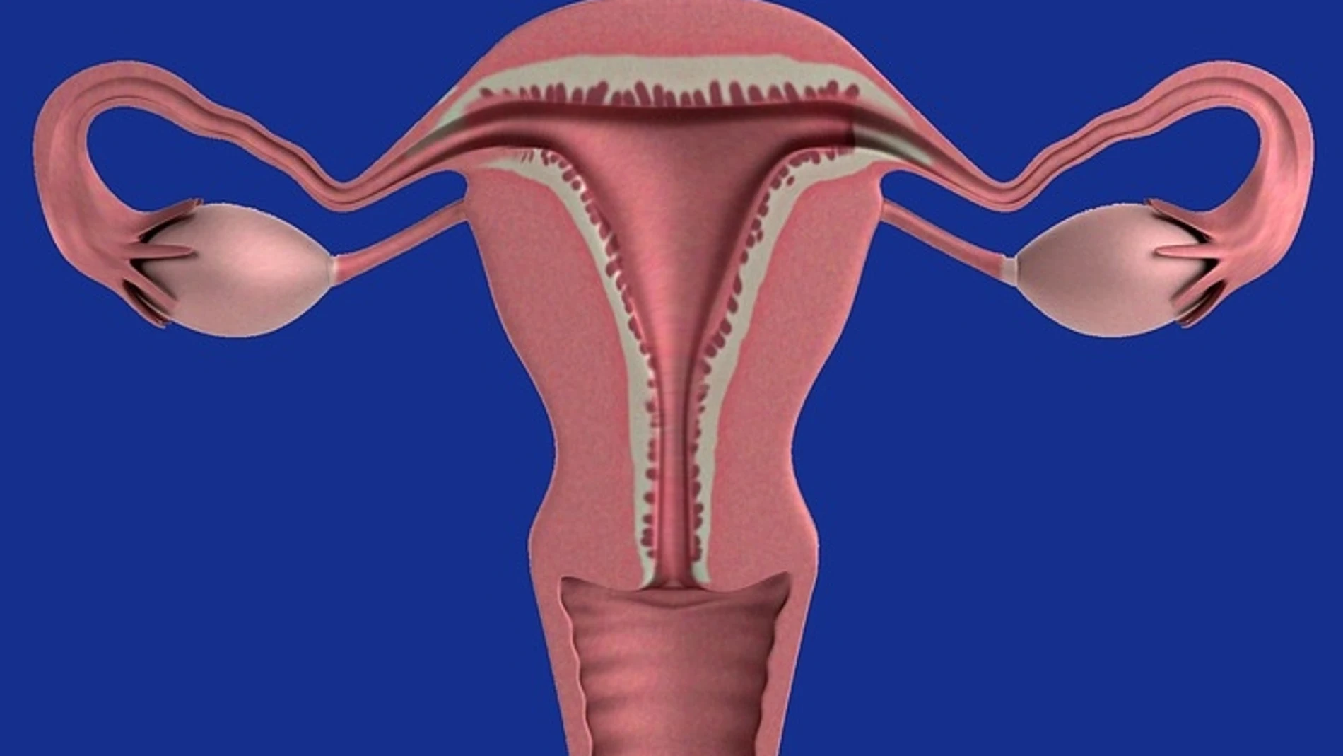 El hiperandrogenismo ovárico funcional, más conocido como síndrome de ovarios poliquísticos (SOP), es un desorden hormonal provocado por una alteración de la función ovárica.