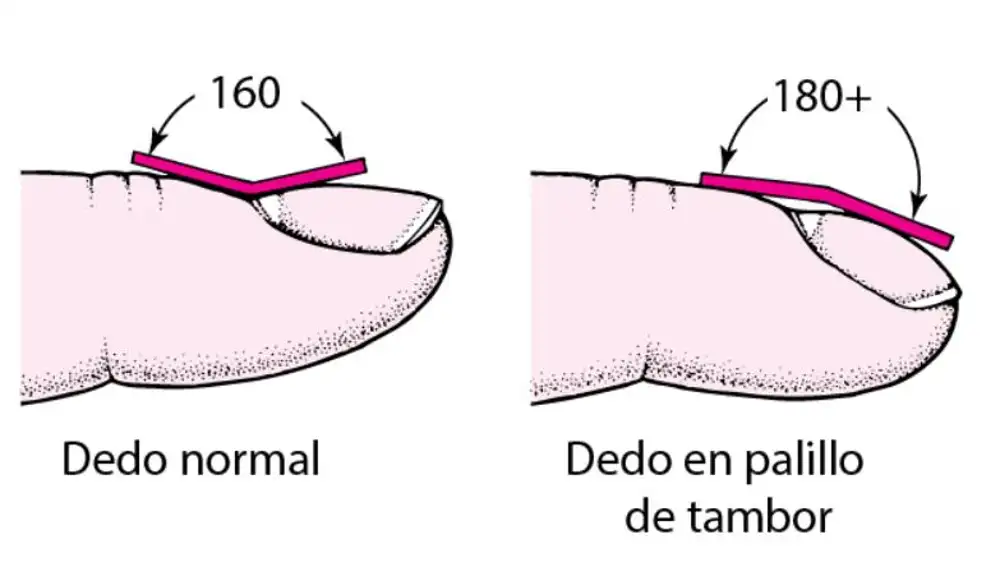 Los dedos en palillo de tambor pueden indicar un trastorno pulmonar o de las vías respiratorias | Fuente: Merck Manuals