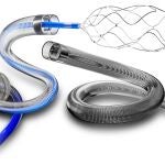 Esta tecnolog&iacute;a sanitaria ya est&aacute; disponible para los especialistas m&eacute;dicos, habitualmente integrados en grupos multidisciplinarios de tratamiento de lesiones vasculares cerebrales.