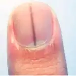 Una línea negra trasversal en la uña podría ser la manifestación de un melanoma| Fuente: Lashkar.in