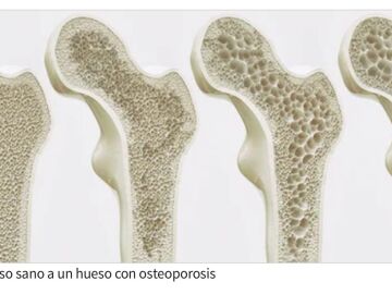 A partir de los 50 a&ntilde;os, 1 de cada 3 mujeres y 1 de cada 5 hombres sufrir&aacute;n, alguna vez en su vida, una fractura por causa de la osteoporosis.