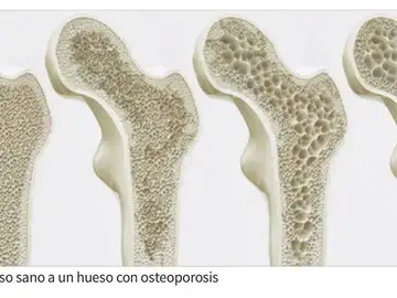 A partir de los 50 años, 1 de cada 3 mujeres y 1 de cada 5 hombres sufrirán, alguna vez en su vida, una fractura por causa de la osteoporosis. A partir de los 50 años, 1 de cada 3 mujeres y 1 de cada 5 hombres sufrirán, alguna vez en su vida, una fractura por causa de la osteoporosis.