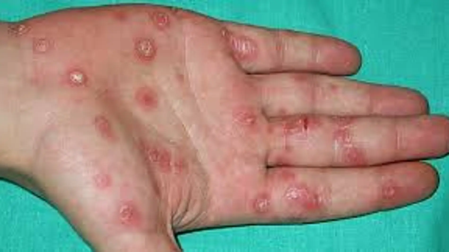 Gonorrea en una mano