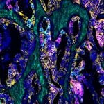 Imagen de cáncer colorrectal rico en ácido hialurónico.