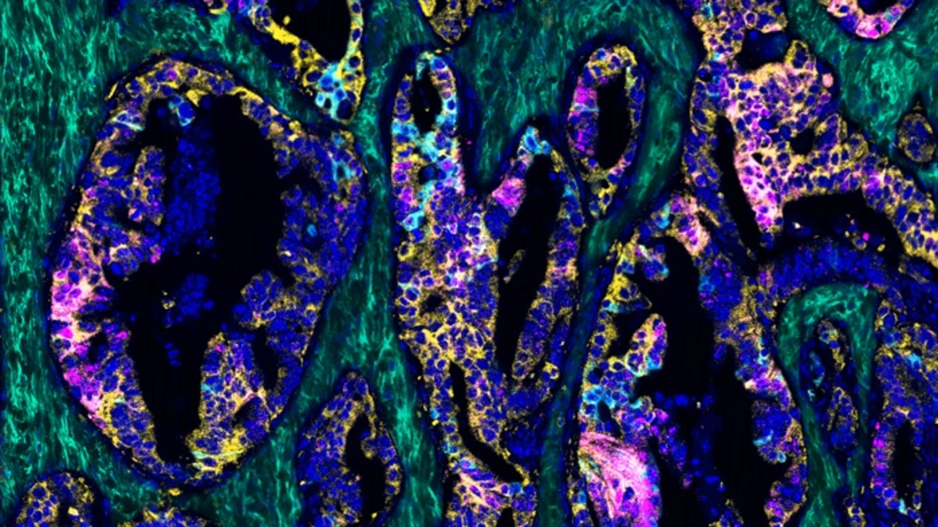 Imagen de cáncer colorrectal rico en ácido hialurónico.