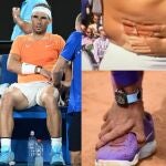 Las lesiones que mortifican a Nadal