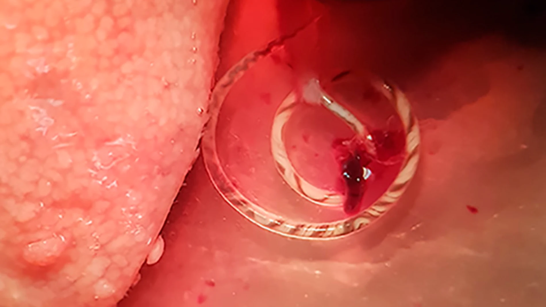 Puede transmitirse a los humanos por vía alimentaria tanto de caracoles parasitados crudos o poco cocinados como por verduras. UV