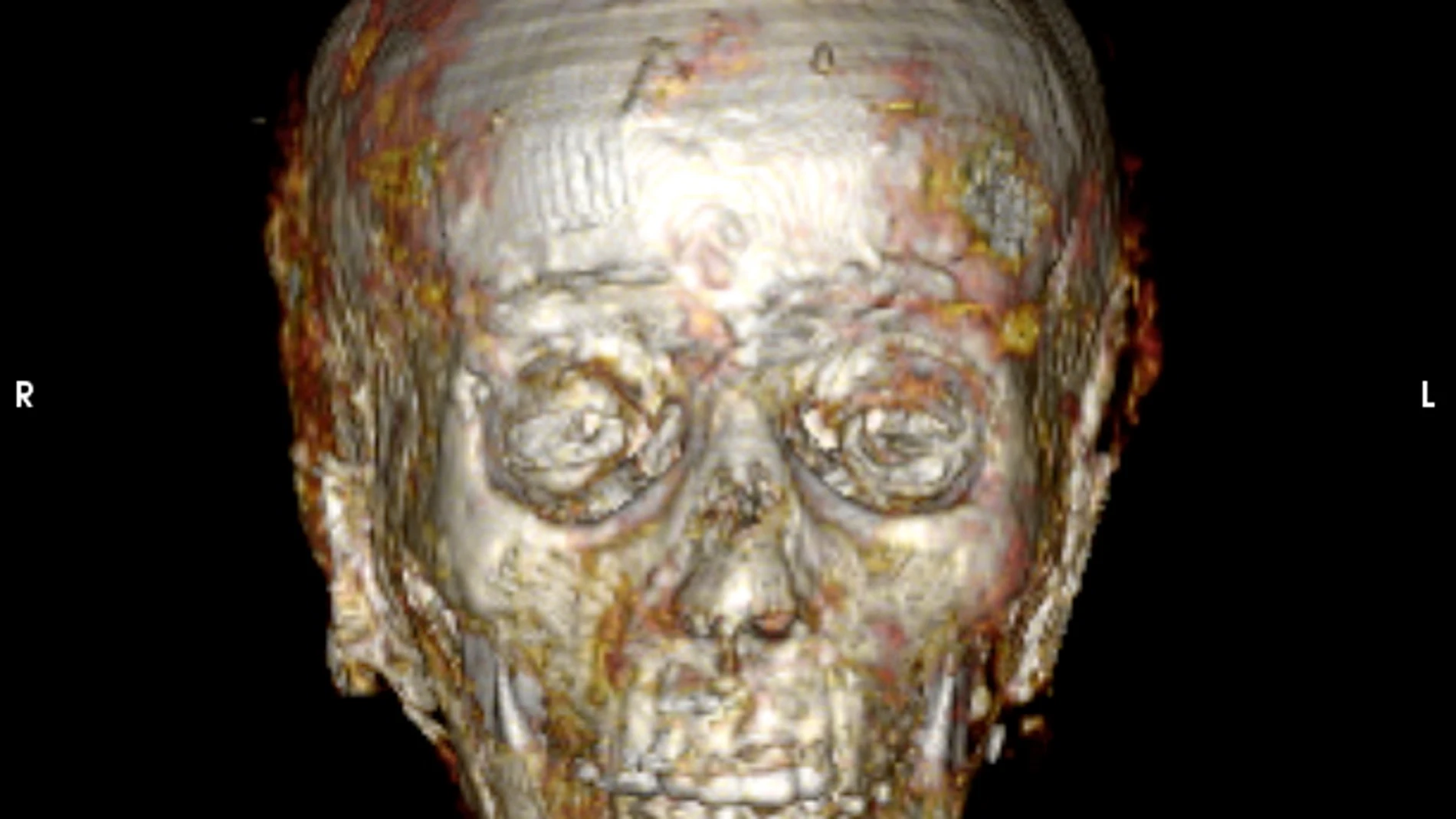 A handout photo made available 24 January 2023 by the Ministry of Tourism and Antiquities shows computed tomography (CT) scans and three-dimensional printing revealing the secrets of the 2,300 old golden boy's mummy at the Egyptian Museum. The 'Äògolden mummy'Äô had been stored in the basement of the Egyptian Museum in Cairo for more than a century prior to its analysis; the latter led to a scientific study published on January 24, 2023 in the journal Frontiers in Medicine by Dr. Sahar Saleem, Professor of Radiology at Cairo University, Egypt. The mummy was discovered completely wrapped in a tomb dated to the Ptolemaic Period (circa 300 BC) in Edfu, southern Egypt, in 1916; it was then moved to the Egyptian Museum's basement. Stored and left unexamined for over a century, the mummy was recently studied for the first time by radiologist Dr. Sahar Saleem, using a computed tomography machine located in the garden of the Egyptian Museum. After more than two thousand years of internment, advanced radiology, modern computer programmes, and three-dimensional printing finally revealed the identity of the mummy; Dr. Saleem revealed it to be belonging to a 15 years-old boy. Results of the analysis showed that the mummification was of significantly high quality. The process involved removing the brain through the nostril, removing the viscera through a small incision in the lower abdomen and inserting packs of resins inside the skull and body cavity. According to ancient Egyptian belief, ancient Egyptian embalmers kept the heart inside the body as it was believed to contain the thoughts and emotions of the deceased. In this case, the heart can be seen in the CT images, inside the chest cavity. The CT scans also revealed that the mummy's body was extensively decorated with 49 amulets which were beautifully tucked, in an arrangement of three columns, between the folds of the wrappings and inside the mummy'Äôs body cavity. The amulets were of 21 different shapes inclu