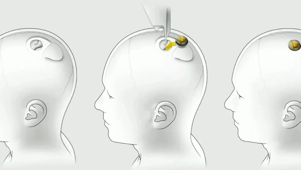 El proyecto Neuralink de Elon Musk pretende comunicar el cerebro humano con un ordenador a través de un chip intracraneal