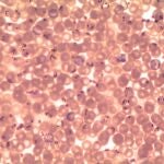 Microfotografía de una muestra de sangre que revela la presencia de numerosos parásitos en forma de anillo de Plasmodium falciparum.