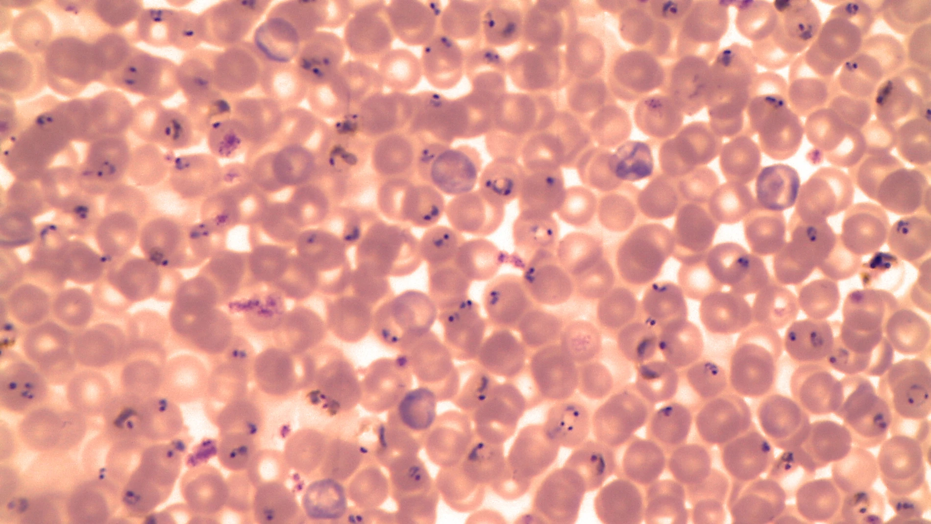 Microfotografía de una muestra de sangre que revela la presencia de numerosos parásitos en forma de anillo de Plasmodium falciparum.