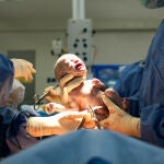 Bebé recién nacido en un parto por cesárea