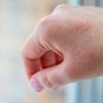 Alergia al frío