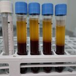 El tratamiento con plasma enriquecido con plaquetas es mínimamente invasivo ya que basta con una muestra de sangre del paciente