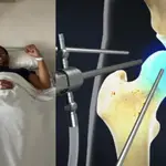 ¿En que consiste la operación de Rafa Nadal y cual es su tiempo de recuperación?: claves para entender su dolorosa lesión