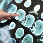 Resultados de la prueba de detección de la esclerosis 