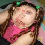 Vitoria tenía sus ojos, nariz y boca desplazados a un lado de la cara debido a la rara enfermedad que sufría