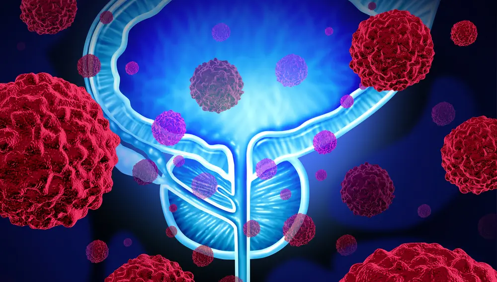 Cáncer de próstata