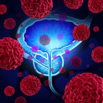 Cáncer de próstata