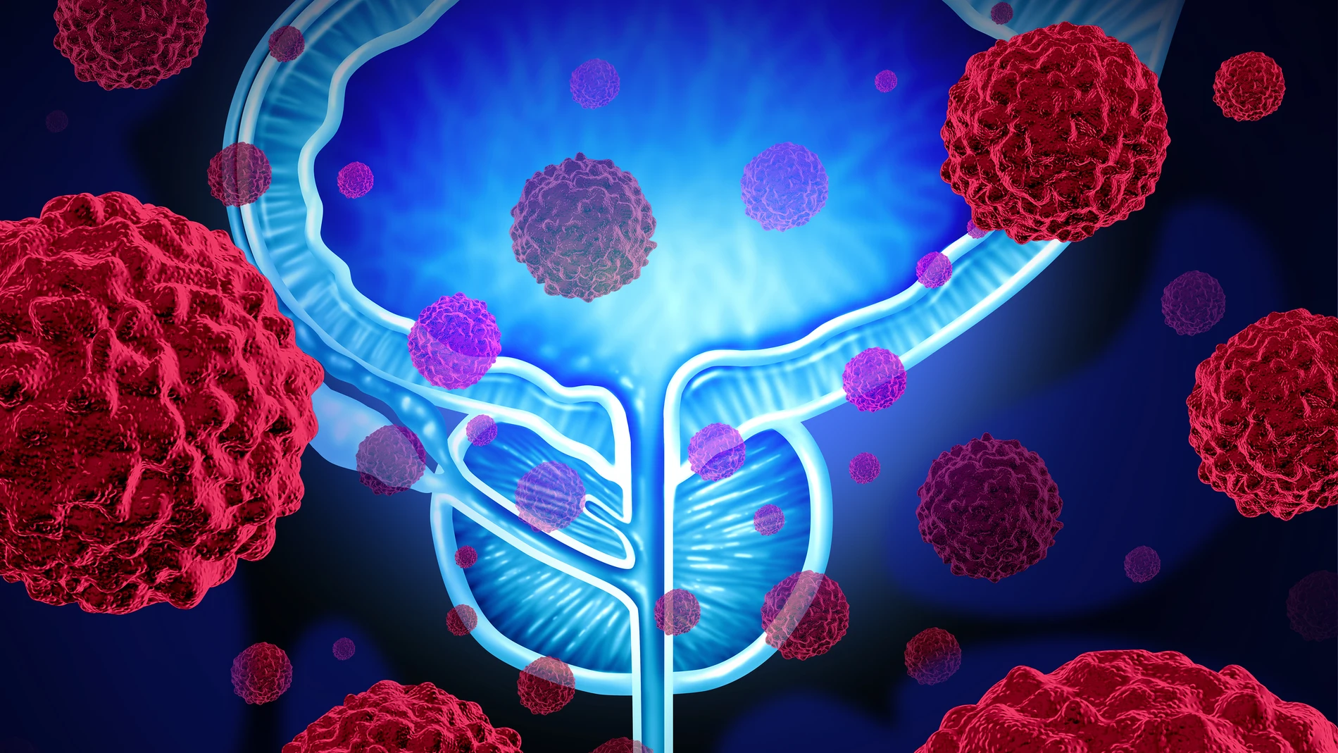 Cáncer de próstata