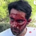 Así ha quedado la cara de Alberto Contador después de su caída en China