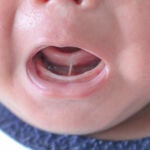 Niño con frenillo sublingual