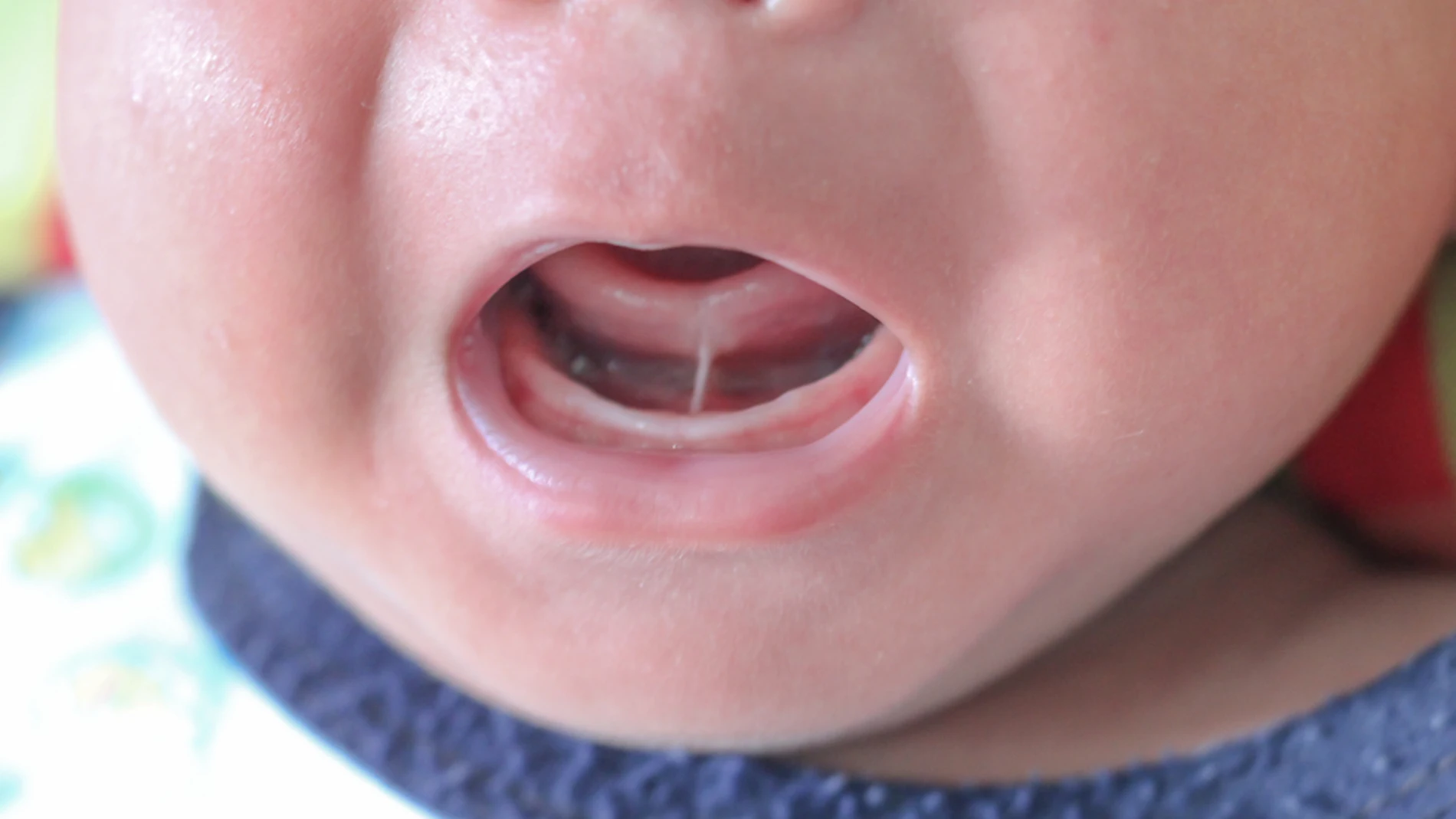 Niño con frenillo sublingual