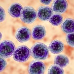 Linfoma