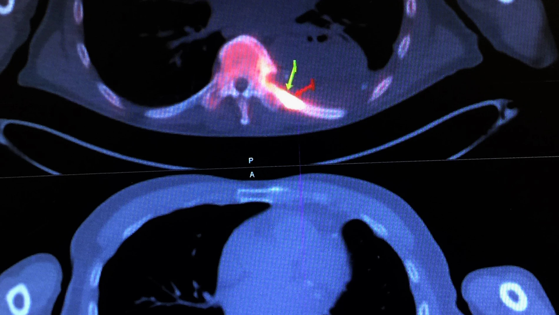 La compresión medular por metástasis es una complicación grave para los pacientes de cáncer.
